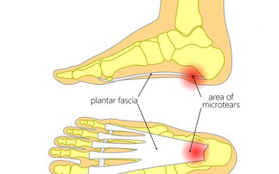 5 fakta om plantar fascitt øvelser