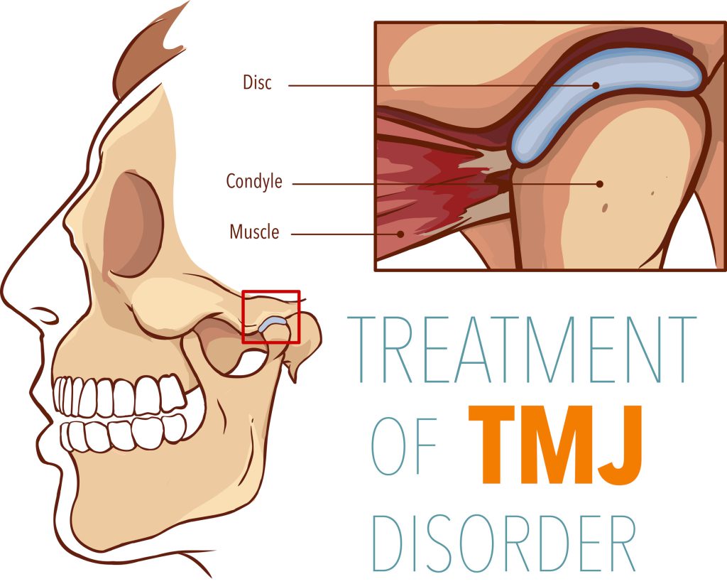 Kjevesmerter illustrasjon av TMJ