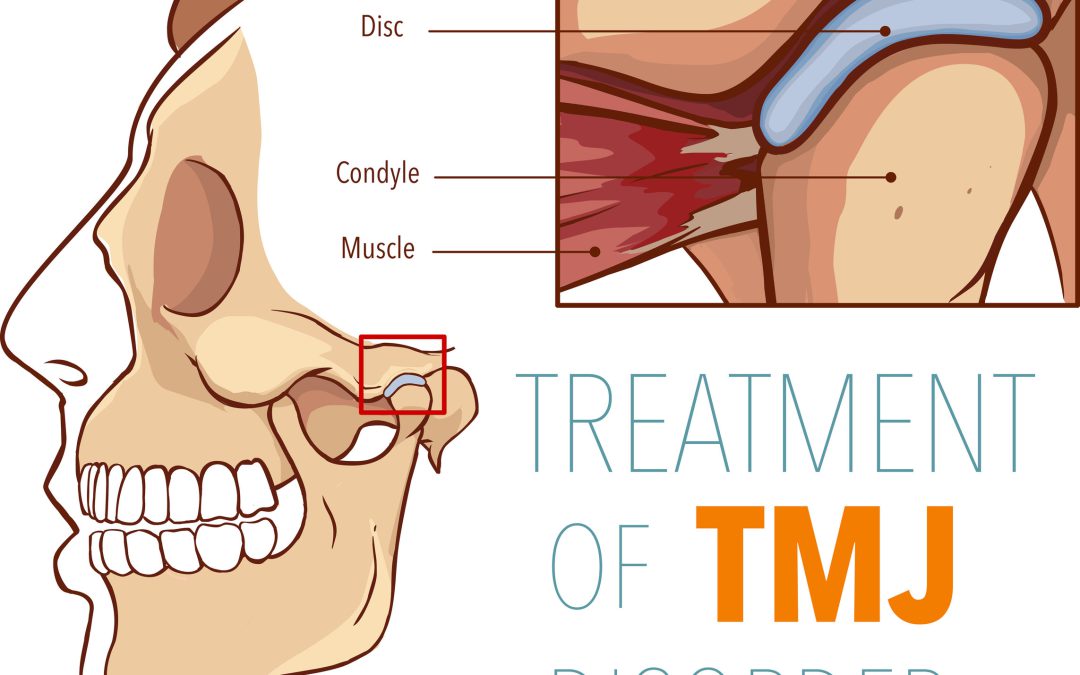 kjeveplager og kjevesmerter bildet er en illustrasjon av TMJ