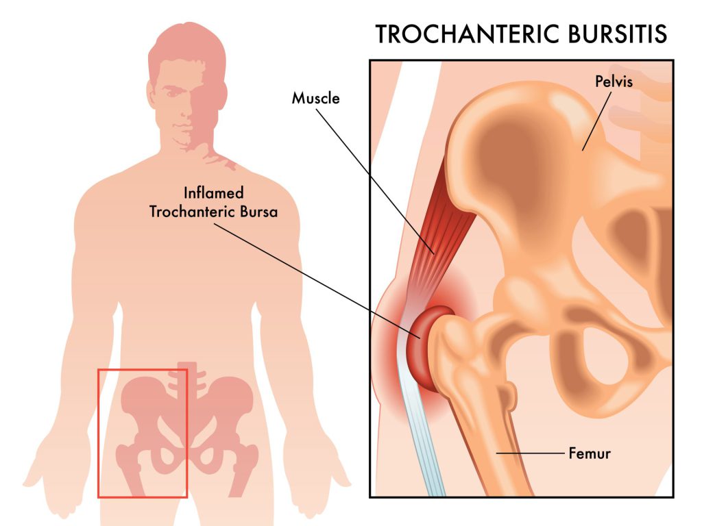 Hofte bursitt- trochanter major smertesyndrom 1