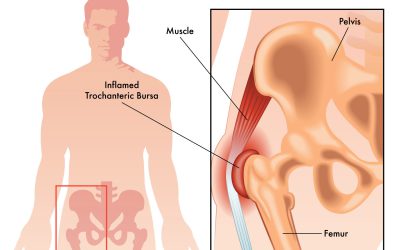 Hofte bursitt- trochanter major smertesyndrom