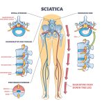 spinal stenose