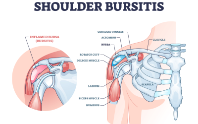Skulder bursitt: smertefull betennelse i slimposen