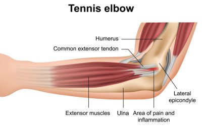 Tennisalbue anatomisk tegning